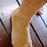 Jelly fish stings in Costa Rica.