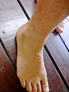 Jelly fish stings in Costa Rica.