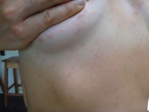 Jelly fish stings in Costa Rica.